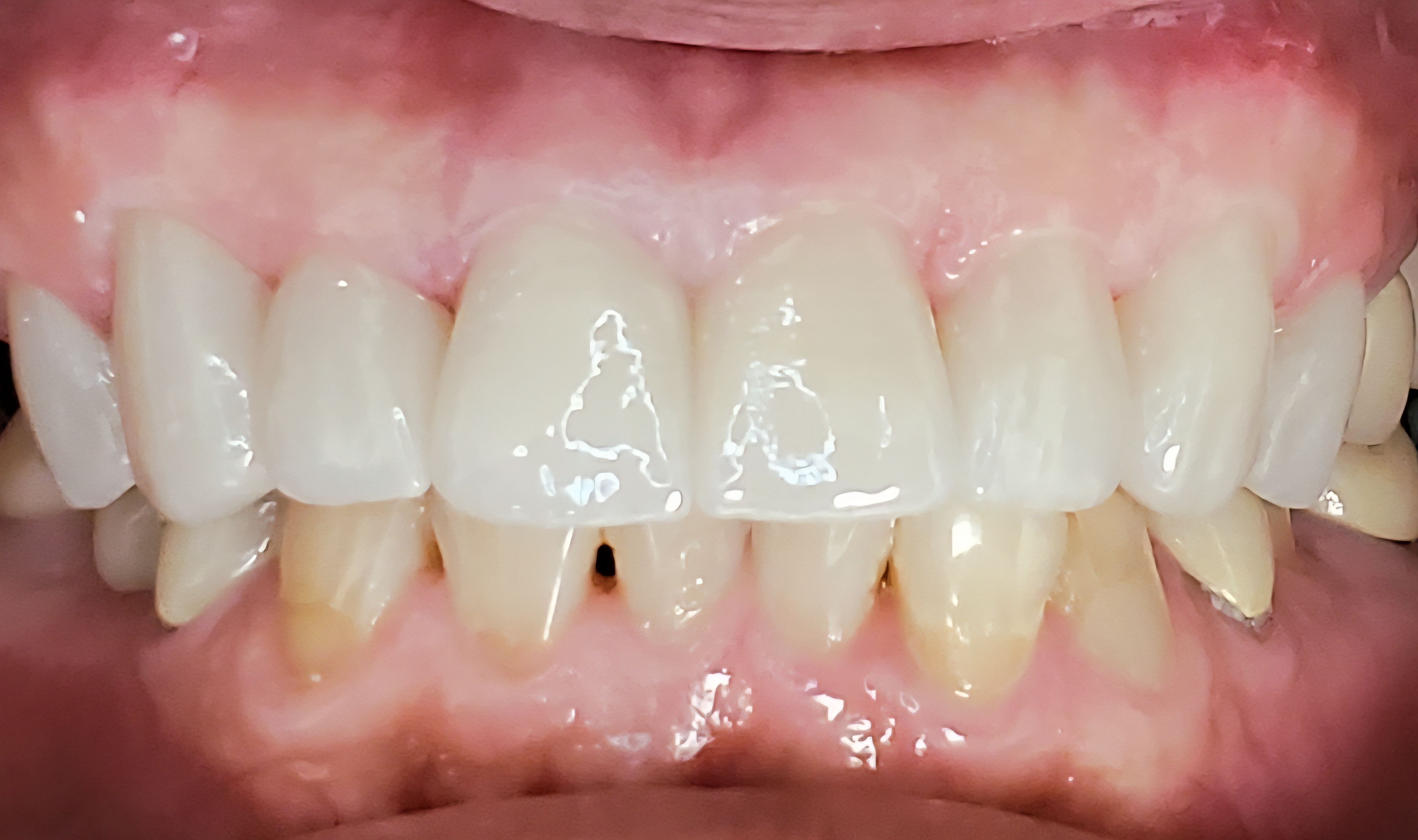 Cosmetic dentistry after treatment at Elm Ridge Implant and Family Dentistry in Killeen, TX